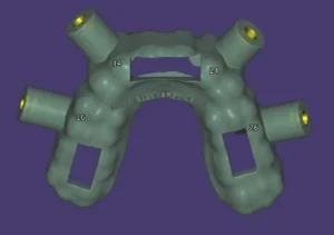 ferulas guiadas microtornillos