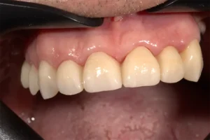 tecnica bopt 3